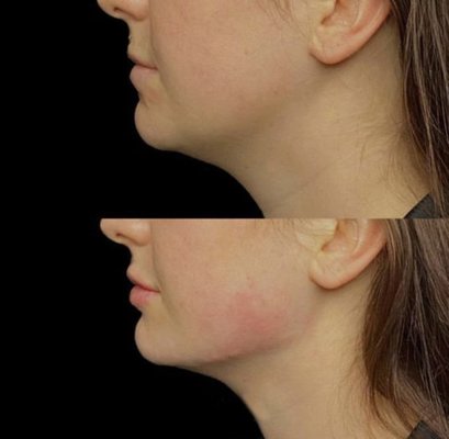 Before and After - Before and after of multiple treatments being done @ Radiant Med Spa by our team of highly skilled medical professionals. Before and After - Before and after of multiple treatments being done @ Radiant Med Spa by our team of highly skilled medical professionals.