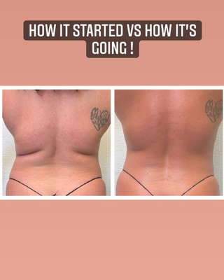 Body Sculpting Results - Get LASTING RESULTS for 6-12 months with our body sculpting services. We work with ALL TYPES of body shapes and sizes to REDUCE the areas you're looking to make changes in. Staff is CERTIFIED with the state of California to ensure your health and safety. These services are NON-INVASIVE and offer an instant solution to an otherwise long process. These are real people with real results, inquire today about what we can do for you! Body Sculpting Results - Get LASTING RESULTS for 6-12 months with our body sculpting services. We work with ALL TYPES of body shapes and sizes to REDUCE the areas you're looking to make changes in. Staff is CERTIFIED with the state of California to ensure your health and safety. These services are NON-INVASIVE and offer an instant solution to an otherwise long process. These are real people with real results, inquire today about what we can do for you!