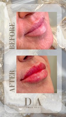 Lips Before and After - Before and After Lips