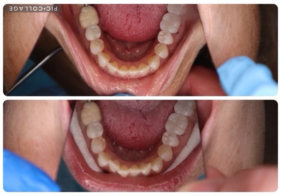 More Than a Beautiful Smile—Invest in Your Long-Term Oral Health - Clear aligners aren't just about achieving a straighter smile—they're an investment in your overall oral health and well-being. At Russell Dental, we believe properly aligned teeth contribute to healthier teeth, gums, and improved function for years to come.
When teeth are crowded, rotated, or spaced improperly, they can be more difficult to clean. Even with excellent brushing and flossing habits, plaque and bacteria can accumulate in hard-to-reach areas, increasing the risk of cavities, gum disease, and persistent bad breath. Straighter teeth are easier to keep clean, making it simpler to maintain excellent oral hygiene.
Proper tooth alignment also helps distribute biting forces more evenly across your teeth. This can reduce excessive wear, chipping, fractures, and stress on individual teeth, helping preserve your natural smile and dental restorations.
Additional health benefits of clear aligner treatment may include:
Improved ability to brush and floss effectively
Reduced risk of tooth decay and periodontal (gum) disease
More balanced bite forces that help protect teeth from excessive wear
Reduced strain on the jaw joints (TMJ) for some patients
Improved chewing efficiency and comfort
Better speech in certain cases where tooth position affects pronunciation
Easier maintenance of crowns, implants, bridges, and other dental restorations
Less food trapping between crowded teeth
Improved long-term stability of your bite
Increased confidence in both personal and professional settings
Our custom clear aligners are:
✔ Virtually invisible
✔ Comfortable and removable
✔ Custom-designed for your smile
✔ Free of metal brackets and wires
✔ Designed to fit your lifestyle
Every smile is unique. We begin with a comprehensive examination and digital scan to determine whether clear aligners are the right solution for you. Throughout treatment, we'll monitor your progress to ensure your teeth are moving safely and predictably.
At Russell Dental, our goal isn't simply to create beautiful smiles—it's to help patients achieve healthier smiles that function well for a lifetime. Whether you're looking to improve aesthetics, correct crowding, enhance your bite, or protect your long-term oral health, clear aligners can be an excellent option.
A straighter smile is more than cosmetic—it's part of a strong foundation for lifelong dental health.
Results vary by patient. A comprehensive examination is required to determine if clear aligner treatment is appropriate. More Than a Beautiful Smile—Invest in Your Long-Term Oral Health - Clear aligners aren't just about achieving a straighter smile—they're an investment in your overall oral health and well-being. At Russell Dental, we believe properly aligned teeth contribute to healthier teeth, gums, and improved function for years to come.
When teeth are crowded, rotated, or spaced improperly, they can be more difficult to clean. Even with excellent brushing and flossing habits, plaque and bacteria can accumulate in hard-to-reach areas, increasing the risk of cavities, gum disease, and persistent bad breath. Straighter teeth are easier to keep clean, making it simpler to maintain excellent oral hygiene.
Proper tooth alignment also helps distribute biting forces more evenly across your teeth. This can reduce excessive wear, chipping, fractures, and stress on individual teeth, helping preserve your natural smile and dental restorations.
Additional health benefits of clear aligner treatment may include:
Improved ability to brush and floss effectively
Reduced risk of tooth decay and periodontal (gum) disease
More balanced bite forces that help protect teeth from excessive wear
Reduced strain on the jaw joints (TMJ) for some patients
Improved chewing efficiency and comfort
Better speech in certain cases where tooth position affects pronunciation
Easier maintenance of crowns, implants, bridges, and other dental restorations
Less food trapping between crowded teeth
Improved long-term stability of your bite
Increased confidence in both personal and professional settings
Our custom clear aligners are:
✔ Virtually invisible
✔ Comfortable and removable
✔ Custom-designed for your smile
✔ Free of metal brackets and wires
✔ Designed to fit your lifestyle
Every smile is unique. We begin with a comprehensive examination and digital scan to determine whether clear aligners are the right solution for you. Throughout treatment, we'll monitor your progress to ensure your teeth are moving safely and predictably.
At Russell Dental, our goal isn't simply to create beautiful smiles—it's to help patients achieve healthier smiles that function well for a lifetime. Whether you're looking to improve aesthetics, correct crowding, enhance your bite, or protect your long-term oral health, clear aligners can be an excellent option.
A straighter smile is more than cosmetic—it's part of a strong foundation for lifelong dental health.
Results vary by patient. A comprehensive examination is required to determine if clear aligner treatment is appropriate.