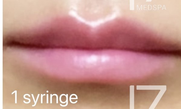 Lip Filler - This patient did not want over-dramatic difference on her lips, but wanted to make sure her lips were plump and looking great with and without lipstick. She absolutely loved the results!