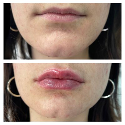 Before & After - Take a look at some of our before and after fillers. We use special techniques to minimize the bruising and swelling.