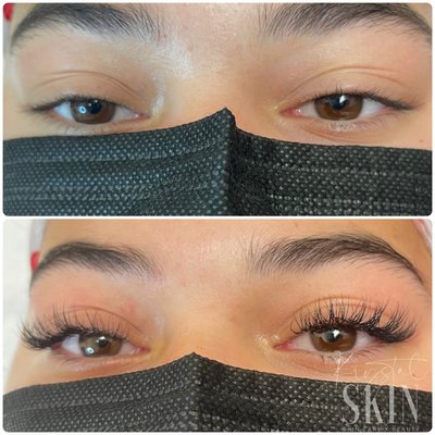 Hydrafacial - Classic Eyelash Extension application. Individual eyelash extensions are placed in a 1:1 ratio to wit lash adhesive enhance the length and look of the lash line.