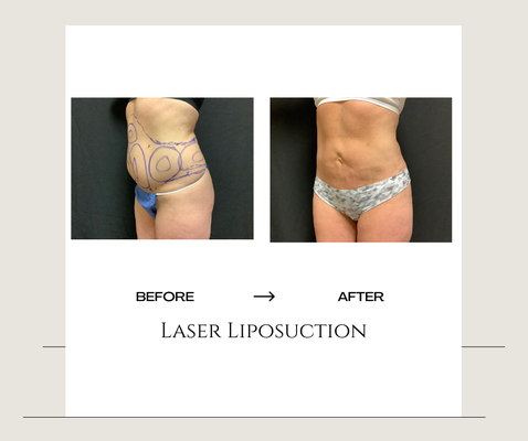 Laser Lipo - Dr. Bailey uses two forms of technology for body contouring, Scitons Laser-assisted Liposuction and InMode’s BODY TITE, which is Radio Frequency Assisted Liposuction, both, are minimally invasive procedures that provide exceptional BODY CONTOURING results without the worry of large scars or prolonged downtime associated with more invasive AESTHETIC SURGERIES. Both are great solutions for patients seeking natural-looking results without visible scars. Radiofrequency is superb at skin tightening and the perfect treatment to improve the appearance of skin after weight loss, pregnancy, or natural aging.