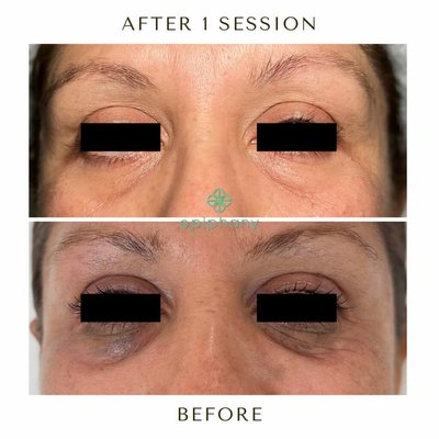 Fotona Laser Treatmetns - Fotona Face is a cutting-edge laser treatment offered at Epiphany Medspa & Wellness in Fullerton, CA. This advanced treatment utilizes a dual-wavelength laser system that combines the unique laser-tissue interaction characteristics of Er: YAG and Nd: YAG lasers. Fotona Face is a non-invasive procedure that can significantly help improve the overall appearance and health of the skin. During a Fotona Face treatment, the laser energy is delivered to the targeted areas of the face, stimulating collagen production and promoting cellular regeneration. As a result, fine lines, wrinkles, acne scars, and uneven skin tone are reduced. The treatment can also tighten sagging skin and improve skin texture. Fotona Laser Treatmetns - Fotona Face is a cutting-edge laser treatment offered at Epiphany Medspa & Wellness in Fullerton, CA. This advanced treatment utilizes a dual-wavelength laser system that combines the unique laser-tissue interaction characteristics of Er: YAG and Nd: YAG lasers. Fotona Face is a non-invasive procedure that can significantly help improve the overall appearance and health of the skin. During a Fotona Face treatment, the laser energy is delivered to the targeted areas of the face, stimulating collagen production and promoting cellular regeneration. As a result, fine lines, wrinkles, acne scars, and uneven skin tone are reduced. The treatment can also tighten sagging skin and improve skin texture.