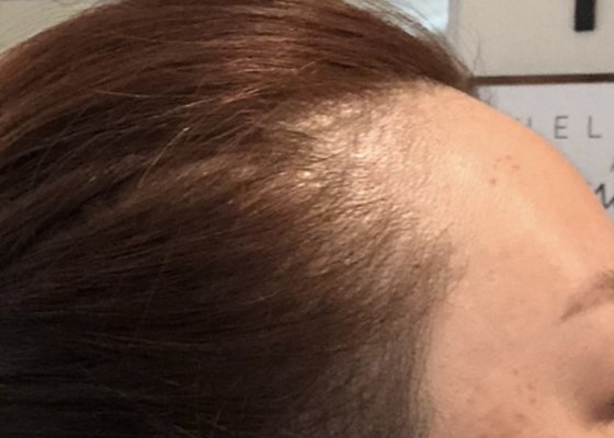Hair Regeneration - This patient's one of many aging symptoms was losing her hair especially around her hairline! 17MedSpa really rolled up their sleeves to work that hair roots to come out! Now the patient's concerned about having too much new baby hair growing - happy concern!