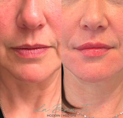 Revanesse® Lips+ - A subtle enhancement not only refreshes your smile, but also supports harmony with the rest of your facial features 💋

The goal isn’t “bigger”—it’s better balance, soft definition, and collagen support for lips that look like you, only more refreshed.