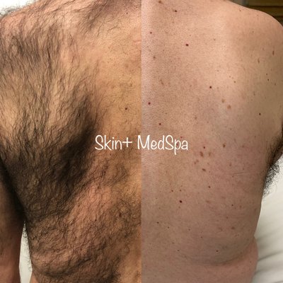 Laser Hair Removal - Elite Laser: safe and effective for all skin types. Book your hair removal session today!