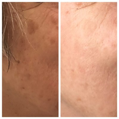 Hyperpigmentation and sun damage treatment using IPL - Hyperpigmentation and sun damage treatment using IPL (Intense Pulsed Light) Hyperpigmentation and sun damage treatment using IPL - Hyperpigmentation and sun damage treatment using IPL (Intense Pulsed Light)