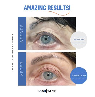 Sofwave skin tightening/lifting and cellulite treatment - Sofwave™ comfortably delivers Synchronous Ultrasound Parallel Beam SUPERB™ technology, with minimal downtime in a single 30-45-minute treatment no matter the skin type.
Starting in our mid-20s, collagen and elastin begin to break down, causing our skin to wrinkle and lose its elasticity. Sofwave™ is a clinically proven, non-invasive approach to remodeling collagen, which improves facial lines and wrinkles and a lifting effect to the eyebrows, neck, and submental region.
High patient satisfaction - in a multi-center clinical study, 72% of the patients were satisfied with their results and rated them as improved to very much improved. Realself rating is 82% WORTH IT! ELLE Future of beauty winner 2021! 2023 New Beauty Award Winner - best for cellulite! Sofwave skin tightening/lifting and cellulite treatment - Sofwave™ comfortably delivers Synchronous Ultrasound Parallel Beam SUPERB™ technology, with minimal downtime in a single 30-45-minute treatment no matter the skin type.
Starting in our mid-20s, collagen and elastin begin to break down, causing our skin to wrinkle and lose its elasticity. Sofwave™ is a clinically proven, non-invasive approach to remodeling collagen, which improves facial lines and wrinkles and a lifting effect to the eyebrows, neck, and submental region.
High patient satisfaction - in a multi-center clinical study, 72% of the patients were satisfied with their results and rated them as improved to very much improved. Realself rating is 82% WORTH IT! ELLE Future of beauty winner 2021! 2023 New Beauty Award Winner - best for cellulite!