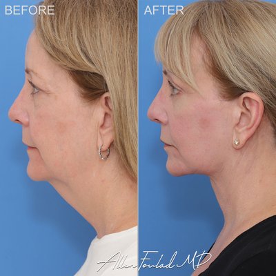 Deep Plane Lower Facelift & Neck Lift - This procedure lifts the midface and jowls, improves jawline definition, lifts the neck, and reduces excess skin at the face and neck. The technique used by Dr. Foulad yields very natural appearing results with well hidden incisions.