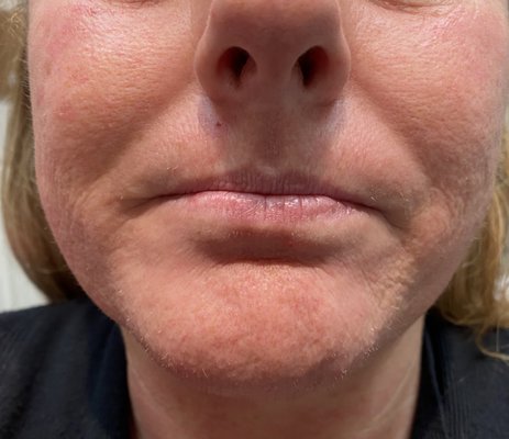 Lip Augmentation - Lip augmentation/Lip filler Lip Augmentation - Lip augmentation/Lip filler