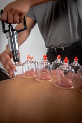 Cupping Therapy for Back Pain - Cupping Therapy helps individuals who have restrictions in their muscle tissues by increasing blood flow and breaking up adhesions (scar tissue). Cupping Therapy for Back Pain - Cupping Therapy helps individuals who have restrictions in their muscle tissues by increasing blood flow and breaking up adhesions (scar tissue).