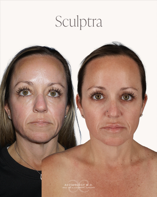 Scupltra - Sculptra is a collagen biostimulator that gradually restores facial volume by stimulating your body's own collagen production. Unlike traditional fillers, Sculptra works over time to improve skin quality, firmness, and structural support for natural, long-lasting rejuvenation.
Whether you've experienced age-related volume loss or changes in your facial contours after significant weight loss, including treatment with GLP-1 medications, Sculptra gradually rebuilds your own collagen to restore natural-looking support and facial balance. The result is subtle, progressive rejuvenation that looks like you, only refreshed. Scupltra - Sculptra is a collagen biostimulator that gradually restores facial volume by stimulating your body's own collagen production. Unlike traditional fillers, Sculptra works over time to improve skin quality, firmness, and structural support for natural, long-lasting rejuvenation.
Whether you've experienced age-related volume loss or changes in your facial contours after significant weight loss, including treatment with GLP-1 medications, Sculptra gradually rebuilds your own collagen to restore natural-looking support and facial balance. The result is subtle, progressive rejuvenation that looks like you, only refreshed.