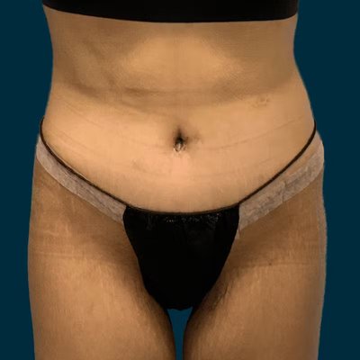 Body Lift - 360 full body lift (belt lipectomy) by Dr. Gavin Dry. 34 year old female patient. Post-op images were captured at 1 week. Body Lift - 360 full body lift (belt lipectomy) by Dr. Gavin Dry. 34 year old female patient. Post-op images were captured at 1 week.