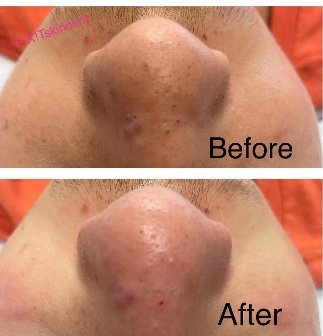 ACNE FACIAL - Specifically designed for acne-prone skin, this facial targets the root causes of acne for clearer, healthier-looking skin. ACNE FACIAL - Specifically designed for acne-prone skin, this facial targets the root causes of acne for clearer, healthier-looking skin.