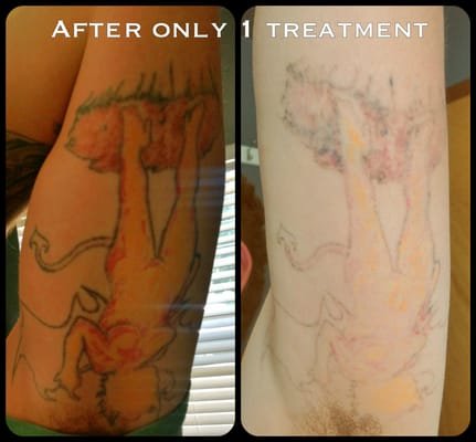 Laser Tattoo Removal Results - This is a laser tattoo removal treatment with our Q Plus C Laser. Our laser is considered the Ferarri of laser tattoo removals. It attacks all ink colors, and is the best laser for your skin.