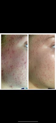 Acne Treatments - Reduce acne scarring with a custom treatment plan