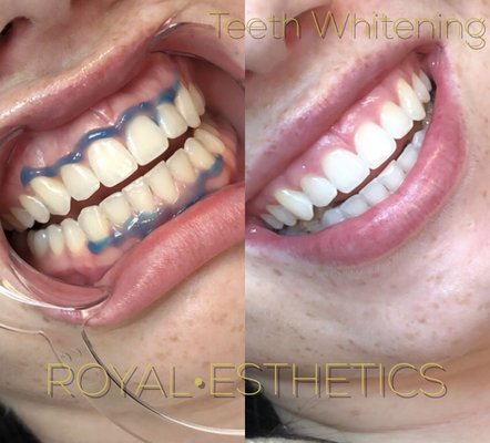 Teeth Whitening - Instant Results - Instant Results
3-6 Shades Brighter
30-60 Minute Session
No filters Teeth Whitening - Instant Results - Instant Results
3-6 Shades Brighter
30-60 Minute Session
No filters