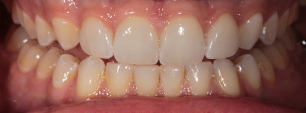 Porcelain Veneers - We love the transformation in our patient's smile and he is much happier as well :). Dr. Bassiri was able to change the shape of the patient's teeth by using almost no prep veneers and enhance his overall smile. Porcelain Veneers - We love the transformation in our patient's smile and he is much happier as well :). Dr. Bassiri was able to change the shape of the patient's teeth by using almost no prep veneers and enhance his overall smile.