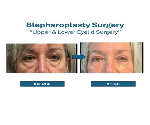 Upper & Lower Eyelid Surgery "Blepharoplast" - Blepharoplasty is a surgical procedure that improves the appearance of your eyelids. It helps reduce the look of tired eyes from your lower lids and removes drooping skin from your upper lids. While the surgery is typically safe, there are risks involved. Talk to our plastic surgeon today. call us now!
