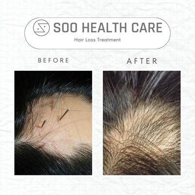 Alopecia Treatment - This patient had a diagnosis of alopecia/hair loss, target at the top center of his head. With several treatment of acupuncture and electric stimulation he regained growth of hair follicles to areas of loss. Alopecia Treatment - This patient had a diagnosis of alopecia/hair loss, target at the top center of his head. With several treatment of acupuncture and electric stimulation he regained growth of hair follicles to areas of loss.