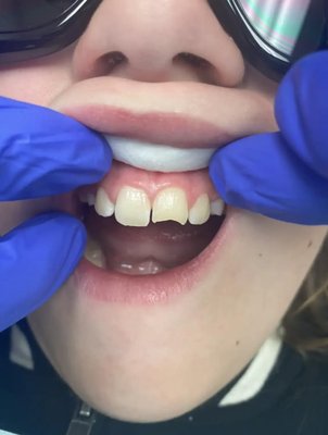 Cosmetic Dentistry - Esthetic composite repair of fracture front tooth Cosmetic Dentistry - Esthetic composite repair of fracture front tooth