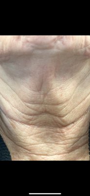 Before & After/ most popular treatments - Our most popular treatments based on results and comfort level. Once you discover Sofwave and Neurotris Microcurrent therapies, you never want to try anything else for tightening. Before & After/ most popular treatments - Our most popular treatments based on results and comfort level. Once you discover Sofwave and Neurotris Microcurrent therapies, you never want to try anything else for tightening.