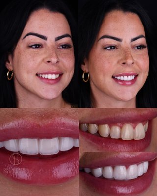 Smile Transformations! - At Ember Dental, we are committed to providing top-quality dental care that transforms smiles and enhances lives. Specializing in cosmetic dentistry, our practice combines advanced technology with a patient-centered approach to deliver stunning, natural-looking results. Whether you’re seeking teeth whitening, veneers, or a complete smile makeover, our expert team is dedicated to helping you achieve the confidence that comes with a radiant smile. At Ember Dental, we believe that every smile tells a story, and we’re here to make yours unforgettable. Experience compassionate care and personalized treatment plans designed to meet your unique dental needs. Smile Transformations! - At Ember Dental, we are committed to providing top-quality dental care that transforms smiles and enhances lives. Specializing in cosmetic dentistry, our practice combines advanced technology with a patient-centered approach to deliver stunning, natural-looking results. Whether you’re seeking teeth whitening, veneers, or a complete smile makeover, our expert team is dedicated to helping you achieve the confidence that comes with a radiant smile. At Ember Dental, we believe that every smile tells a story, and we’re here to make yours unforgettable. Experience compassionate care and personalized treatment plans designed to meet your unique dental needs.