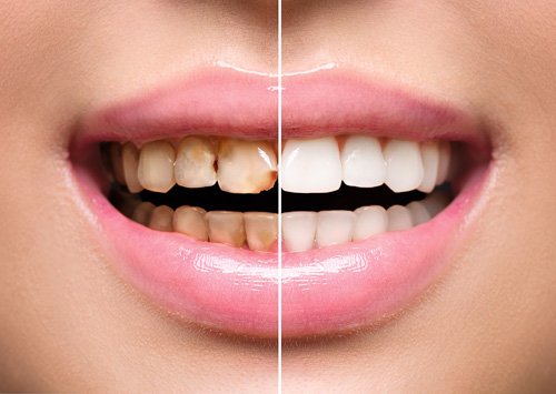 Cosmetic Dentistry - Cosmetic Dentistry Phases
At Foothill Family Dental, our forte is the mastery of beautiful smiles harmonious with nature.
Our laboratory work is done by master ceramists. Cosmetic Dentistry and Porcelain Veneers are made by a team that has done this over and over again.
1. Consultation
Cosmetic Dentistry is something to look forward to. In your initial consultation, we discuss the goals and the case criteria in basic and general terms. Once the patient has decided to make us his/her New Smile Consultant then we proceed to the next phase.
2. Taking Impressions
The patient has a quick and convenient X-Ray. Impressions of upper and lower teeth are taken. Models from these will later be mounted on a device to analyze your bite and to make a design for your future smile.
3. Prototype Approval Appointment
This is the active appointment where changes are performed on the teeth and impressions are taken for the fabrication of the new smile. Teeth are prepared to receive the final restoration. Impressions are taken and sent to the lab after the patient approves of the prototype design by his/her Cosmetic Dentist. Esthetic restorations are made to mimic the final smile.
4. Final Smile Insertion Appointment
This is when we bond the final dental restorations. The teeth are tried in to assure a perfect match with the Prototypes by an index obtained earlier from the Prototypes. The bite is adjusted, and x rays taken to confirm the perfect fit. Photographs are taken again. Patients have a range of positive emotions to see the remarkable change in their appearance. This is the occasion to celebrate.
Whether you are looking to make small tweaks to the color or overall shape of your smile or you are contemplating a full cosmetic makeover, our dental team here at Foothill Family Dental is here to make sure that cosmetic dentistry fulfills your smile goals. We can work with you to provide you with the quality, customized treatment or treatments you need to get that straighter, whiter, and more attractive smile.
Are you interested in our Cosmetic Dentistry Services?
Call Foothill Family Dental in Foothill Ranch, CA at (949) 273-8600
for more information or to book an appointment!
Proudly serving the People of the Foothill Ranch and Lake Forest, CA area. Cosmetic Dentistry - Cosmetic Dentistry Phases
At Foothill Family Dental, our forte is the mastery of beautiful smiles harmonious with nature.
Our laboratory work is done by master ceramists. Cosmetic Dentistry and Porcelain Veneers are made by a team that has done this over and over again.
1. Consultation
Cosmetic Dentistry is something to look forward to. In your initial consultation, we discuss the goals and the case criteria in basic and general terms. Once the patient has decided to make us his/her New Smile Consultant then we proceed to the next phase.
2. Taking Impressions
The patient has a quick and convenient X-Ray. Impressions of upper and lower teeth are taken. Models from these will later be mounted on a device to analyze your bite and to make a design for your future smile.
3. Prototype Approval Appointment
This is the active appointment where changes are performed on the teeth and impressions are taken for the fabrication of the new smile. Teeth are prepared to receive the final restoration. Impressions are taken and sent to the lab after the patient approves of the prototype design by his/her Cosmetic Dentist. Esthetic restorations are made to mimic the final smile.
4. Final Smile Insertion Appointment
This is when we bond the final dental restorations. The teeth are tried in to assure a perfect match with the Prototypes by an index obtained earlier from the Prototypes. The bite is adjusted, and x rays taken to confirm the perfect fit. Photographs are taken again. Patients have a range of positive emotions to see the remarkable change in their appearance. This is the occasion to celebrate.
Whether you are looking to make small tweaks to the color or overall shape of your smile or you are contemplating a full cosmetic makeover, our dental team here at Foothill Family Dental is here to make sure that cosmetic dentistry fulfills your smile goals. We can work with you to provide you with the quality, customized treatment or treatments you need to get that straighter, whiter, and more attractive smile.
Are you interested in our Cosmetic Dentistry Services?
Call Foothill Family Dental in Foothill Ranch, CA at (949) 273-8600
for more information or to book an appointment!
Proudly serving the People of the Foothill Ranch and Lake Forest, CA area.