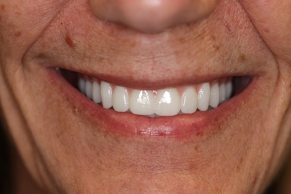 All-On-X (Full Arch) 4 - This patient wanted to eat with confidence and get her smile back! What are you waiting for?