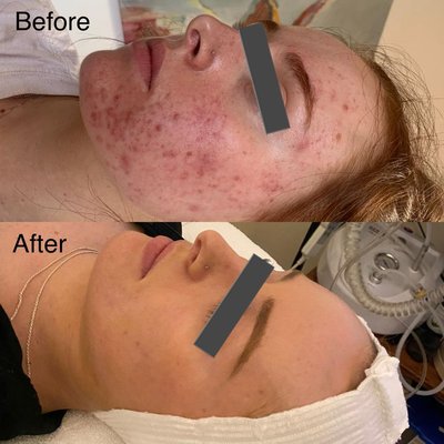 Microdermabrasion + Enzyme Peel add-on - Microdermabrasion combined with an enzyme peel add-on is the best treatment for a wide variety of conditions, including acne, aging, blemishes, fine lines, uneven skin, and wrinkles. Microdermabrasion + Enzyme Peel add-on - Microdermabrasion combined with an enzyme peel add-on is the best treatment for a wide variety of conditions, including acne, aging, blemishes, fine lines, uneven skin, and wrinkles.
