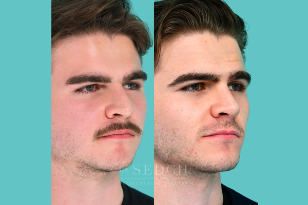 Male Rhinoplasty - These male rhinoplasty results demonstrate precision-focused surgical outcomes designed to improve nasal function, structure, and facial proportion. Each case reflects a measured approach that prioritizes natural aesthetics and masculine definition.