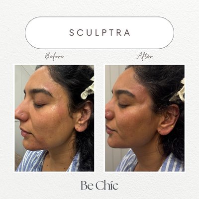 Sculptra - Sculptra® Aesthetic is an FDA-approved facial injectable treatment on the market that helps boost the skin’s own natural collagen production to restore its inner structure. It also provides long-lasting results -- more than two years. Sculptra - Sculptra® Aesthetic is an FDA-approved facial injectable treatment on the market that helps boost the skin’s own natural collagen production to restore its inner structure. It also provides long-lasting results -- more than two years.
