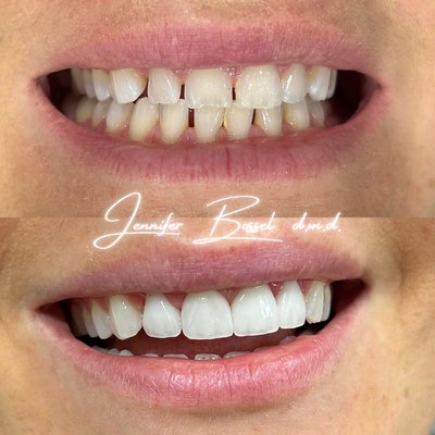 Cosmetic Dentistry - before and after - Before and After shots of our cosmetic cases Cosmetic Dentistry - before and after - Before and After shots of our cosmetic cases