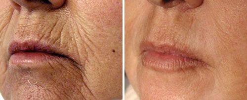 Dynamis Laser before and after - Dynamis laser, this before-and-after highlights dramatic improvements in skin tone, texture, and overall rejuvenation.