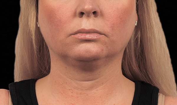 Get CoolSculpting with medspa810 - If you have areas with stubborn pockets of fat and you would like to find a safe, science-backed method to remove them, medspa810 can help you get the results you are looking for with CoolSculpting. CoolSculpting is proven with scientific studies in addition to the millions of procedures that have been performed by practitioners from all over. This FDA-cleared specialized technology is safe and leaves no scarring from incisions or needles. Because the treatment happens below the skin, there is little to no downtime. Medspa810 offers a free consultation to see where you would like fat removed and whether CoolSculpting is right for you. Don’t just imagine results. See them. Take your diet and exercise further with CoolSculpting. Find out more about how CoolSculpting can help you look your best by setting up a free consultation. Contact medspa810 today. Get CoolSculpting with medspa810 - If you have areas with stubborn pockets of fat and you would like to find a safe, science-backed method to remove them, medspa810 can help you get the results you are looking for with CoolSculpting. CoolSculpting is proven with scientific studies in addition to the millions of procedures that have been performed by practitioners from all over. This FDA-cleared specialized technology is safe and leaves no scarring from incisions or needles. Because the treatment happens below the skin, there is little to no downtime. Medspa810 offers a free consultation to see where you would like fat removed and whether CoolSculpting is right for you. Don’t just imagine results. See them. Take your diet and exercise further with CoolSculpting. Find out more about how CoolSculpting can help you look your best by setting up a free consultation. Contact medspa810 today.