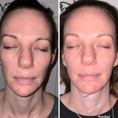 PRX DERM PERFEXION - PRX Derm Perfexion is a cutting-edge, FDA approved, non-invasive service available at Arosa Aesthetics. This advanced treatment harnesses the power of 33% trichloroacetic acid (TCA), hydrogen peroxide, and kojic acid to stimulate collagen production, unveiling smoother texture and a more even tone for your skin.

Administered by our licensed skincare professionals, PRX Derm Perfexion Treatment involves a gentle massage technique, ensuring a relaxing experience throughout. Additionally, each session is complemented with a personalized home care program to enhance and prolong the results.

PRX Derm Perfexion Treatment offers:

✔No needles, no pain
✔Minimal to no downtime
✔Quick 20-30 minute sessions
✔Suitable for all seasons, including summer
✔Complete facial and body rejuvenation

 PRX Derm Perfexion Treatment is perfect for those who want to achieve visible results without sacrificing your busy lifestyle.