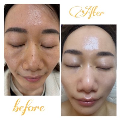 Deep Resurfacing Therapy - ✨ Transform Your Skin with Deep Resurfacing Therapy ✨
Tired-looking skin? Enlarged pores? Dark circles or fine lines? Our Deep Resurfacing Therapy is designed to renew and revitalize your skin from within.
💎 Benefits include:
✔ Smoother skin texture & radiant glow
✔ Minimized pores & reduced dark circles
✔ Wrinkle improvement & brighter skin tone
✔ Visible improvement in acne scars
Experience the power of Korean skincare innovation at Goeun Beauty. Your skin deserves this glow-up! ✨ Deep Resurfacing Therapy - ✨ Transform Your Skin with Deep Resurfacing Therapy ✨
Tired-looking skin? Enlarged pores? Dark circles or fine lines? Our Deep Resurfacing Therapy is designed to renew and revitalize your skin from within.
💎 Benefits include:
✔ Smoother skin texture & radiant glow
✔ Minimized pores & reduced dark circles
✔ Wrinkle improvement & brighter skin tone
✔ Visible improvement in acne scars
Experience the power of Korean skincare innovation at Goeun Beauty. Your skin deserves this glow-up! ✨