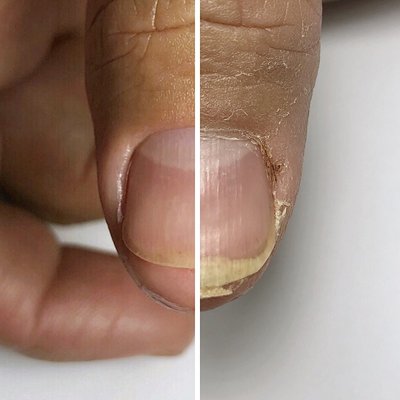 E-file Manicure (Before & After) - What is e-file manicure? 🧐 ⠀ 
So many of you heard of it but not everybody knows what exactly e-file manicure is and why it’s called “e-file”. ⠀⠀ ⠀

First of all e-file means electric file. We use special high quality electric files to exfoliate keratinized tissue without touching living tissues on clients hands and surrounding areas of the natural nails. We teach only safe techniques and also we have an actual nail salon @amelina_paraiso where you can experience high quality services 🐾🖤🔝 ⠀ ⠀

All our bits going through cleaning, disinfection and sterilization processes (we have medical grade autoclave) 🦠🙅🏼‍♀️ ⠀ ⠀ ⠀

Our nail files & nail brushes for 1 time use only 🙌🏼 ⠀ 
We do not use water to soak hands or feet. No water means no contamination of bacterial infections, viruses, fungal infection or parasites 👌🏼 ⠀