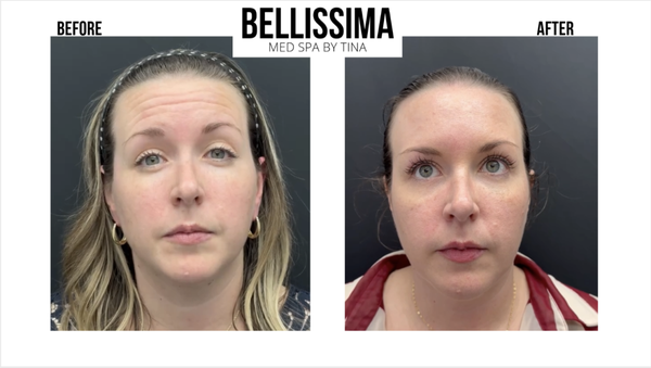 Lip Filler - Age 25-35
Procedure: 20 units nuerotoxin in glabella, 20 units in frontalis
Duration: 20 min
Results: 2 weeks Lip Filler - Age 25-35
Procedure: 20 units nuerotoxin in glabella, 20 units in frontalis
Duration: 20 min
Results: 2 weeks