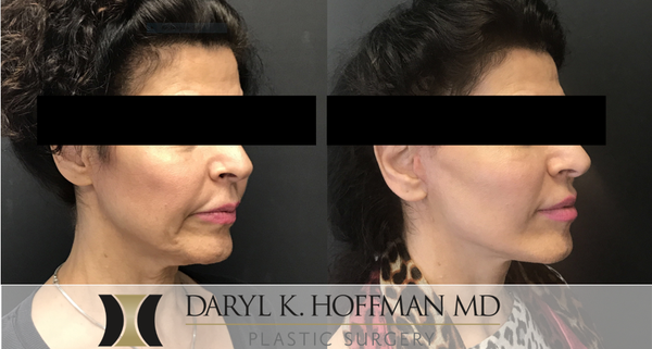 Facelift / Necklift - Over time, the contours of the face and appearance of the facial skin can begin to be affected by gravity, loss of elasticity, exposure to the elements, and everyday stresses of life. To reduce signs of facial aging, board-certified, Stanford-trained plastic surgeon Dr. Daryl K. Hoffman offers facelift surgery for San Jose and Palo Alto, CA, women and men.

Facelifts are designed to smooth the loose skin on the face and neck, minimizing wrinkles and giving the facial area a firmer, more youthful appearance. A facelift may be right for a man or a woman who has developed deep creases between their nose and mouth, excess skin on their cheeks, folds and fat deposits around their neck, or a jawline that has grown slack and jowly.