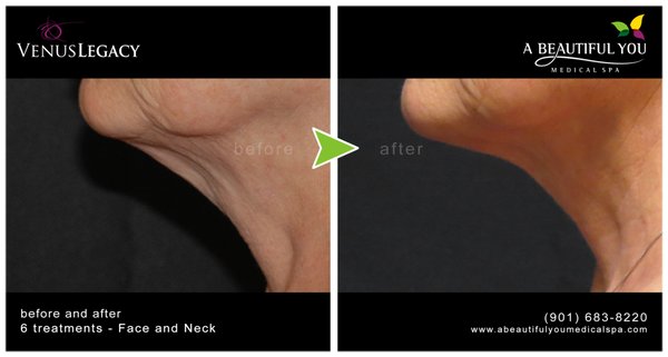 Skin Tightening - Do you feel confident in your skin? If your skin is sagging or marked by cellulite and stretch marks, you may not. That’s why the team at A Beautiful You Medical Spa offers skin tightening with Venus Legacy™ at their office in Memphis, Tennessee. If you’re interested in learning if this noninvasive treatment is right for you, call or text the office today to learn more or schedule a free consultation.