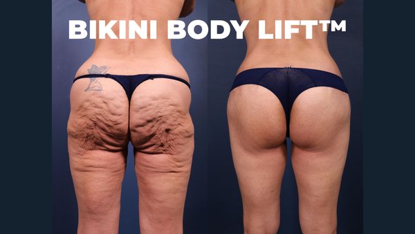 Bikini Body Lift ™ - Bikini body lift™

No other procedure offers the combination of advantages you get with Dr. Stoker's game-changing body contouring technique:
- Dr. Stoker's revolutionary contouring technique
- Dramatically improves the appearance of cellulite on the thighs and buttocks
- Lifts, smooths, and rounds the buttocks without implants, fat, or filler
- Tightens loose skin in the thighs, abdomen, and pubic region
- Effective solution for skin laxity due to menopause, pregnancy, and weight loss
Keeps scars hidden, even in a bikini

Dr. Stoker creates a comprehensive surgical plan to address your specific concerns, combining artistry, technical expertise and vast experience to create the stunning results seen in hundreds of before-and-after photos. If you're concerned about cellulite and skin laxity due to pregnancy, menopause, or weight loss, the Bikini Body Lift™ may be the solution you're seeking.