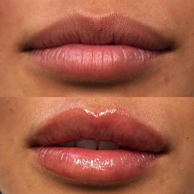 Dermal Fillers at Gravity Med Spa - Fillers are a gel that is injected into various areas of the face to gently lift the skin and restore volume that is lost from aging. It is made from a modified form of hyaluronic acid which is a natural complex sugar that occurs within our bodies. Injectable fillers are great for any patient who suffers from loss of volume in the face.
Patients can expect to be at their filler appointment for around 30-45 minutes with an additional 20 minutes prior to being injected that is for numbing. If you are searching for lip filler near me -- You have found us.