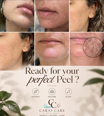 Ready to Glow? - A chemical peel is a skin-resurfacing treatment that gently exfoliates the outer layers of skin, revealing a brighter, smoother, and more even complexion. Ideal for improving texture, minimizing fine lines, and targeting discoloration, this treatment leaves your skin feeling refreshed and rejuvenated Ready to Glow? - A chemical peel is a skin-resurfacing treatment that gently exfoliates the outer layers of skin, revealing a brighter, smoother, and more even complexion. Ideal for improving texture, minimizing fine lines, and targeting discoloration, this treatment leaves your skin feeling refreshed and rejuvenated
