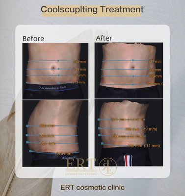 Body Contouring - This male client had his 1st Coolsculpting treatment with 2 cycles at his lower abdomen, showing significant result after 6 weeks, best result will show between 2-3 months. Body Contouring - This male client had his 1st Coolsculpting treatment with 2 cycles at his lower abdomen, showing significant result after 6 weeks, best result will show between 2-3 months.