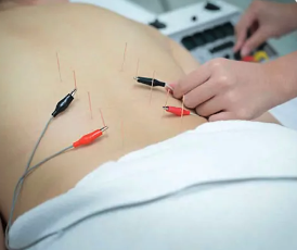 Electro-acupuncture - Electro-acupuncture is acupuncture with mild electric stimulation. While the procedure and process is similar to acupuncture, electroacupuncture has a profound effect on the therapy.
Electro-acupuncture is a powerful tool used to enhance the already powerful the pain relieving and anti-inflammatory aspects of acupuncture. In many patients it is the key to improvement. Electro-acupuncture - Electro-acupuncture is acupuncture with mild electric stimulation. While the procedure and process is similar to acupuncture, electroacupuncture has a profound effect on the therapy.
Electro-acupuncture is a powerful tool used to enhance the already powerful the pain relieving and anti-inflammatory aspects of acupuncture. In many patients it is the key to improvement.