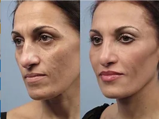 Morphues8 - What precisely is a Morpheus8 Procedure?
The Morpheus8 procedure is characterized by its non-invasive nature, resulting in little to no recovery time after the treatment. Nonetheless, patients should anticipate experiencing moderate facial skin swelling for approximately 3-5 days following their Morpheus8 treatment.
Who is considered an ideal candidate for a Morpheus8 Procedure?
There are no strict age limitations for the Morpheus8 treatment, and the eligibility criteria do not hinge on any specific traits. Essentially, suitable candidates for Morpheus8 are individuals seeking to address concerns such as sagging cheeks, deep facial lines, and localized fat deposits on the face and neck. In essence, those desiring to reverse the signs of facial aging are prime candidates for the Morpheus8 treatment. However, it is crucial for candidates to be in good physical health and maintain realistic expectations regarding the outcomes of the procedure.
Benefits of a Morpheus8 Procedure:
Non-Invasive Approach A Morpheus8 treatment achieves remarkable results without the need for abrasive techniques, ensuring a gentle and effective experience.
Safe for All Skin Types Since the Morpheus8 procedure is non-invasive, there is typically minimal recovery required. However, patients should anticipate approximately 3-5 days of moderate facial skin swelling following the treatment.
Long-Lasting and Natural Results Morpheus8 aims to provide enduring and naturally appearing outcomes.
Swift Recovery Thanks to its non-invasive nature, Morpheus8 treatment usually entails little to no recovery time. Still, patients should anticipate about 3-5 days of moderate facial skin swelling following the procedure. Morphues8 - What precisely is a Morpheus8 Procedure?
The Morpheus8 procedure is characterized by its non-invasive nature, resulting in little to no recovery time after the treatment. Nonetheless, patients should anticipate experiencing moderate facial skin swelling for approximately 3-5 days following their Morpheus8 treatment.
Who is considered an ideal candidate for a Morpheus8 Procedure?
There are no strict age limitations for the Morpheus8 treatment, and the eligibility criteria do not hinge on any specific traits. Essentially, suitable candidates for Morpheus8 are individuals seeking to address concerns such as sagging cheeks, deep facial lines, and localized fat deposits on the face and neck. In essence, those desiring to reverse the signs of facial aging are prime candidates for the Morpheus8 treatment. However, it is crucial for candidates to be in good physical health and maintain realistic expectations regarding the outcomes of the procedure.
Benefits of a Morpheus8 Procedure:
Non-Invasive Approach A Morpheus8 treatment achieves remarkable results without the need for abrasive techniques, ensuring a gentle and effective experience.
Safe for All Skin Types Since the Morpheus8 procedure is non-invasive, there is typically minimal recovery required. However, patients should anticipate approximately 3-5 days of moderate facial skin swelling following the treatment.
Long-Lasting and Natural Results Morpheus8 aims to provide enduring and naturally appearing outcomes.
Swift Recovery Thanks to its non-invasive nature, Morpheus8 treatment usually entails little to no recovery time. Still, patients should anticipate about 3-5 days of moderate facial skin swelling following the procedure.