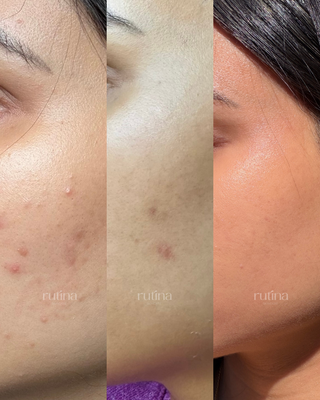 In-Person Acne Healing & Confidence Restoration - Acne is more than just breakouts.
It affects confidence. It changes the way you see yourself.
That’s exactly why I do what I do — to help you feel confident in your skin again.
When she came in, her skin was inflamed, reactive, and stuck in a cycle of constant breakouts. She had never struggled with acne as a teenager. It started suddenly at 27 — adult-onset acne — which can feel incredibly frustrating and confusing.
She had tried everything: countless skincare products, laser treatments, three dermatologists, two estheticians, one endocrinologist, and two gynecologists — but nothing was truly working.
What she was missing wasn’t effort. She was missing a clear, personalized plan and ongoing support every step of the way.
Instead of overwhelming her skin, we focused on:
• A customized acne-safe skincare routine
• Strengthening and protecting the skin barrier
• Calming inflammation instead of attacking the skin
• Consistent, non-invasive professional treatments, including chemical peels and facials
• Adjusting the plan as her skin improved
Her results were achieved over a period of 9 months, with approximately 8 in-studio sessions scheduled every 2–3 weeks. These treatments were combined with consistent home care using acne-specific products, including medical-grade active ingredients, along with proper hydration, barrier support, and supportive lifestyle adjustments.
Advanced treatments such as Glacial Skin Cold Therapy helped accelerate her results by calming inflammation more quickly and supporting deeper skin recovery.
This wasn’t a quick fix — it was structured, strategic care.
And maintaining clear skin long term requires continued support. Ongoing home care, along with advanced facials like the ones I offer, helps preserve results, prevent new breakouts, and keep the skin balanced over time.
The biggest transformation wasn’t just in her skin — it was in her confidence.
If you’re tired of trying random products and endless treatments without real progress, and you’re ready for a personalized acne strategy focused on long-term results, I’d love to help you.
Book your consultation and let’s start your transformation. In-Person Acne Healing & Confidence Restoration - Acne is more than just breakouts.
It affects confidence. It changes the way you see yourself.
That’s exactly why I do what I do — to help you feel confident in your skin again.
When she came in, her skin was inflamed, reactive, and stuck in a cycle of constant breakouts. She had never struggled with acne as a teenager. It started suddenly at 27 — adult-onset acne — which can feel incredibly frustrating and confusing.
She had tried everything: countless skincare products, laser treatments, three dermatologists, two estheticians, one endocrinologist, and two gynecologists — but nothing was truly working.
What she was missing wasn’t effort. She was missing a clear, personalized plan and ongoing support every step of the way.
Instead of overwhelming her skin, we focused on:
• A customized acne-safe skincare routine
• Strengthening and protecting the skin barrier
• Calming inflammation instead of attacking the skin
• Consistent, non-invasive professional treatments, including chemical peels and facials
• Adjusting the plan as her skin improved
Her results were achieved over a period of 9 months, with approximately 8 in-studio sessions scheduled every 2–3 weeks. These treatments were combined with consistent home care using acne-specific products, including medical-grade active ingredients, along with proper hydration, barrier support, and supportive lifestyle adjustments.
Advanced treatments such as Glacial Skin Cold Therapy helped accelerate her results by calming inflammation more quickly and supporting deeper skin recovery.
This wasn’t a quick fix — it was structured, strategic care.
And maintaining clear skin long term requires continued support. Ongoing home care, along with advanced facials like the ones I offer, helps preserve results, prevent new breakouts, and keep the skin balanced over time.
The biggest transformation wasn’t just in her skin — it was in her confidence.
If you’re tired of trying random products and endless treatments without real progress, and you’re ready for a personalized acne strategy focused on long-term results, I’d love to help you.
Book your consultation and let’s start your transformation.